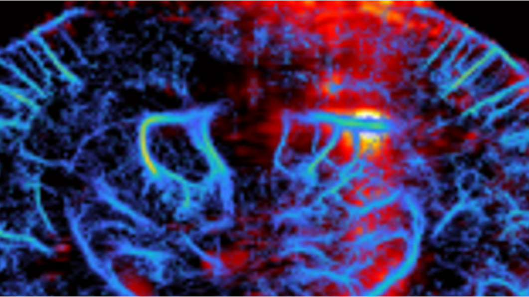 Brain Therapy and monitoring